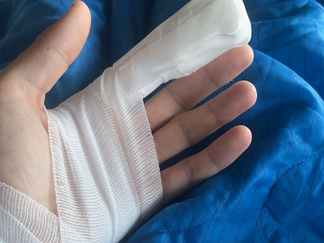 הפציעה ביד (מדיה מכבי עירוני אשדוד)